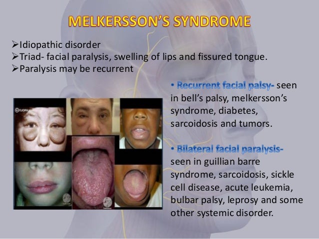 Shayne Ryder From Mofos Idiopathic facial palsy